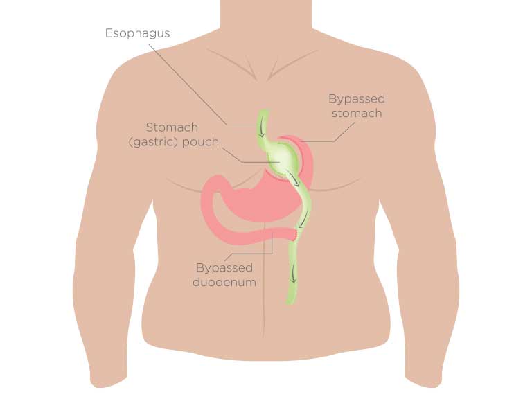 Gastric bypass