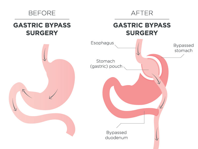 gastric bypass