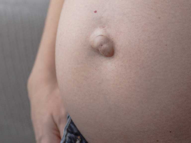 Umbilical hernia