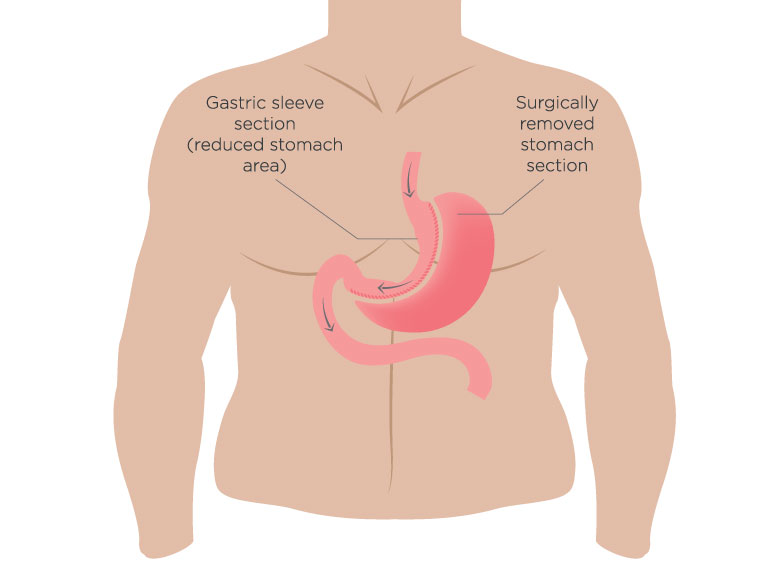 sleeve gastrectomy diagram