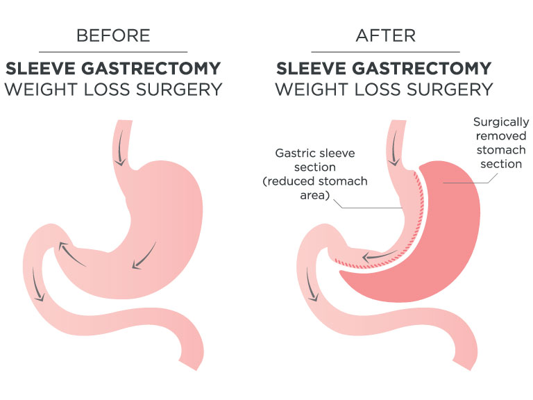 sleeve gastrectomy
